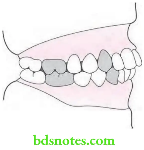 Orthodontics Classification Of Malocclusion Angle's Class 1 Malocclusion