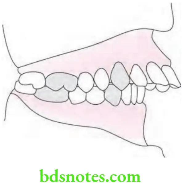 Orthodontics Classification Of Malocclusion Angle's Class 2 Division 1 Malocclusion