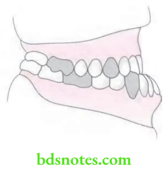 Orthodontics Classification Of Malocclusion Angle's Class 3 Malocclusion 1