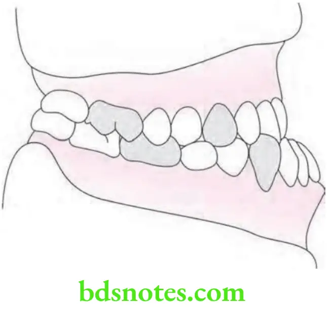 Orthodontics Classification Of Malocclusion Angle's Class 3 Malocclusion