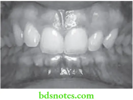 Orthodontics Development Of Dentition And Occlusion Deep Bite