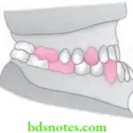 Orthodontics Management Of Class 3 Malocclusion Angle's Class 3 malocclusion