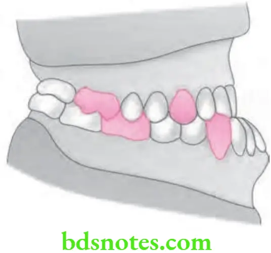 Orthodontics Management Of Class 3 Malocclusion Angle's Class 3 malocclusion