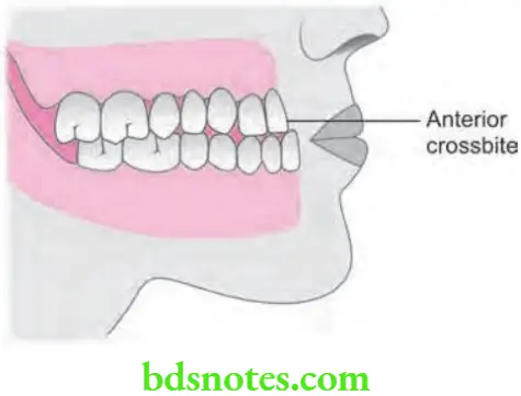 Orthodontics Management Of Cross Bite Anterior crossbite