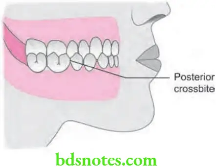 Orthodontics Management Of Cross Bite Posterior crossbite
