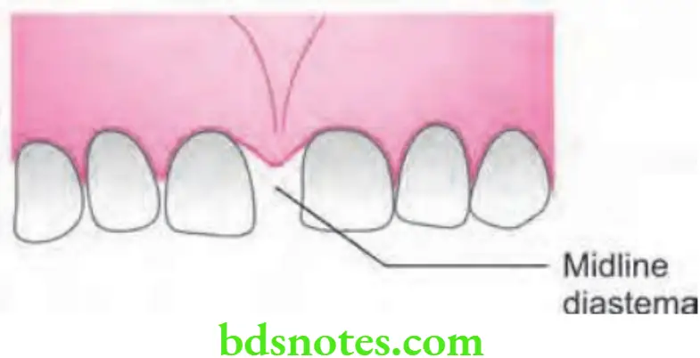 Orthodontics Management Of Some Common Malocclusions Mildline diastema
