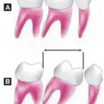 Orthodontics Methods Of Gaining Space Uprighting of Molars