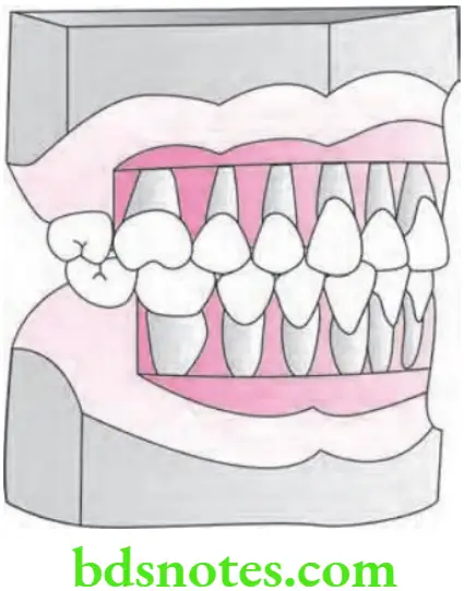 Orthodontics Model Analysis Kesling's diagnostic set-up