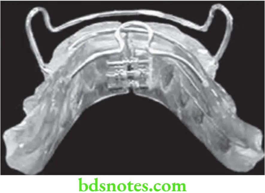 Orthodontics Myofunctional Appliances Bionator