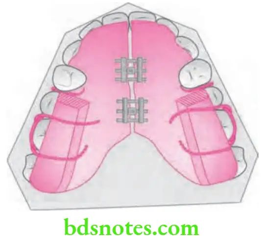 Orthodontics Myofunctional Appliances Twin block appliance