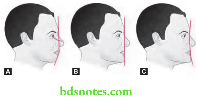 Orthodontics Orthodontic Diagnosis Facial profile (A) Convex, (B) Straight, (C) Concave