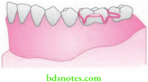 Adams Clasp Theory And Fabrication - BDS Notes