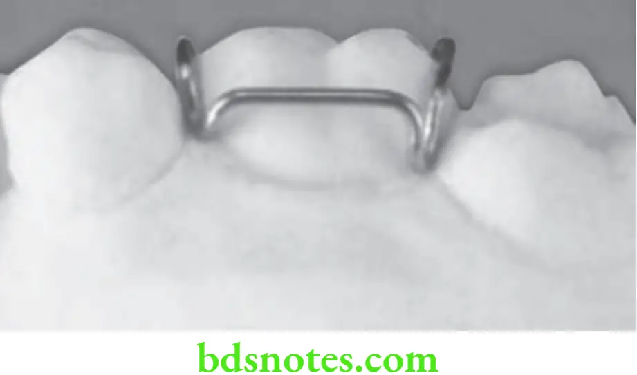 Orthodontics Removable Appliances Adam's clasp