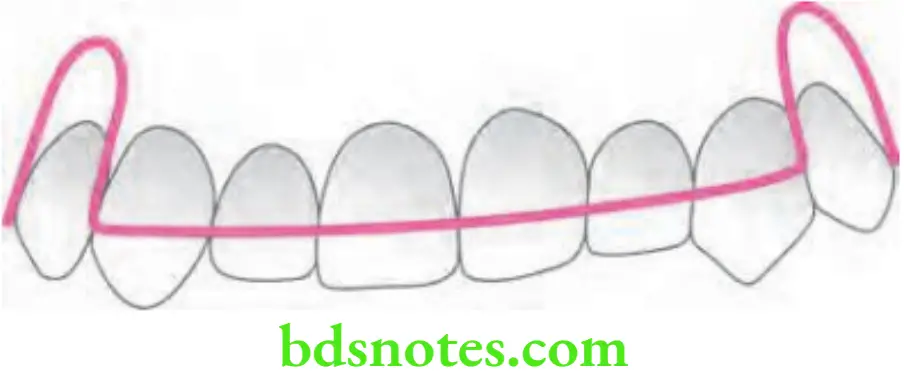 Orthodontics Removable Appliances Long labial bow