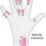 Orthodontics Skeletal Maturity Indicators Fishman's Skeletal Maturity Indicator