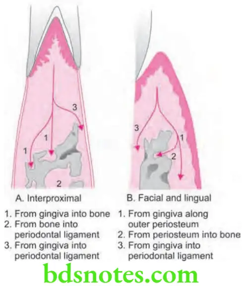 Periodontics Bone Loss And Patterns Of Bone Destruction Pathways of inflammation from gingiva to periodontal tissues