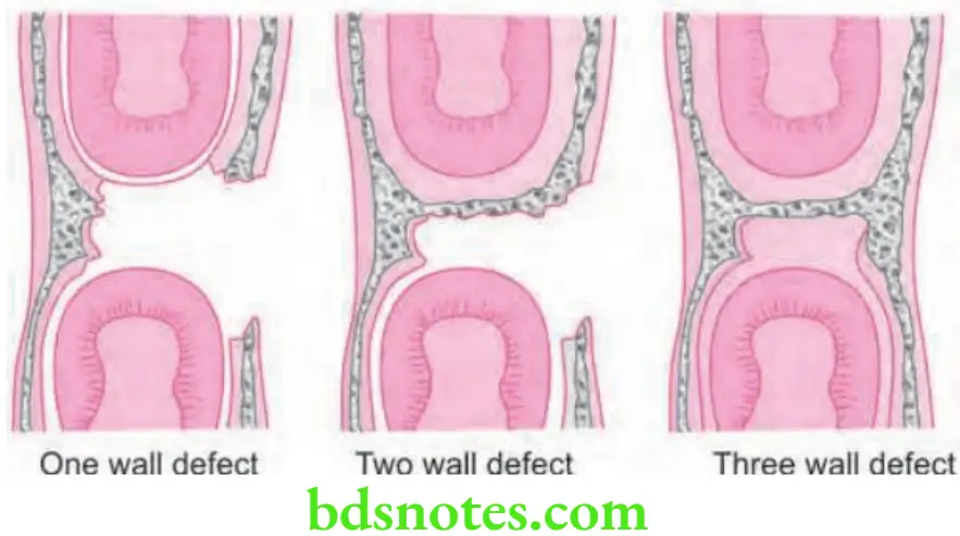 Periodontics Bone Loss And Patterns Of Bone Destruction Vertical and angular bony defect