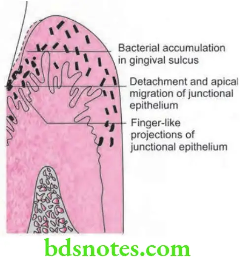 Periodontics Periodontal Pocket Detachment and apical migration of junctional epithelium