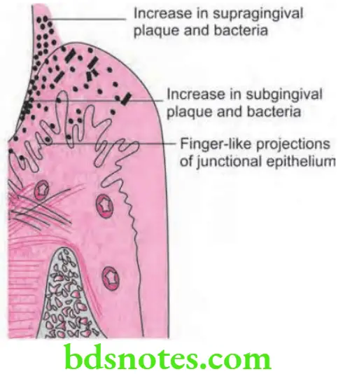 Periodontics Periodontal Pocket Extension of supragingival plaque into the gingival sulcus