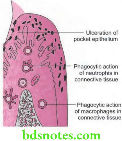 Periodontics Periodontal Pocket Ulceraton of pocket epithelium