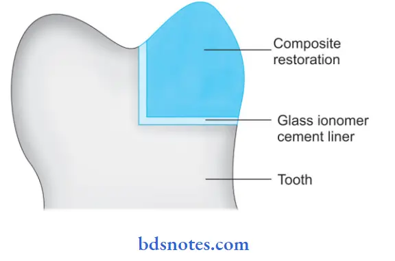Resin Based Composites And Bonding Agents Glass ionpmer linear is sandwitched between tooth and comosite restoration