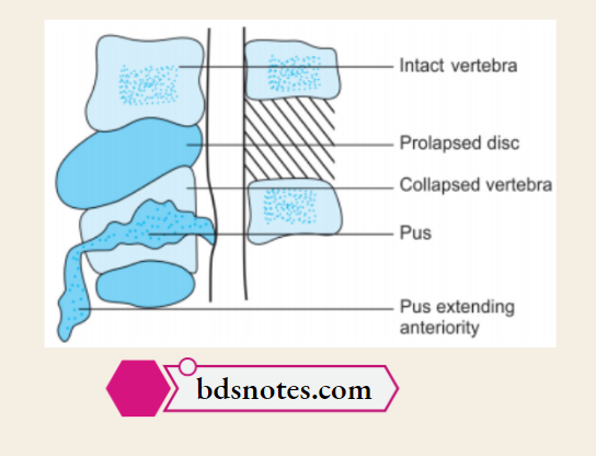 Spinal Degeneration Comparison