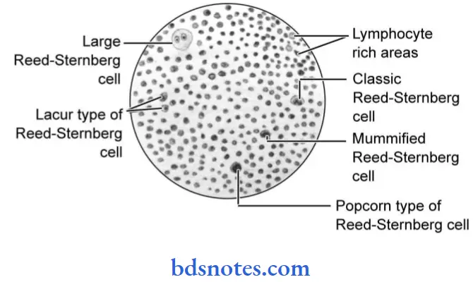 The Lymphoid System Hodgkin's Disease