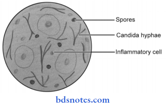 The Oral Cavity And Salivary Glands Candida Albicans (PAS)
