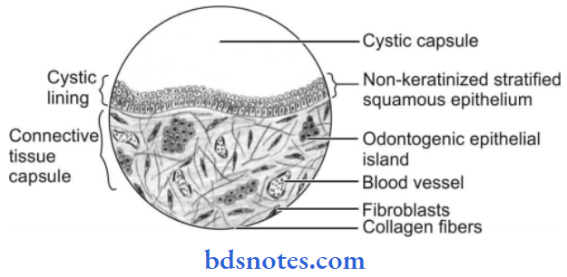 The Oral Cavity And Salivary Glands Inflamed Dentigerous Cyst