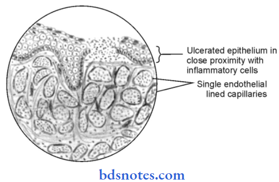 The Oral Cavity And Salivary Glands Pyogenic Granuloma