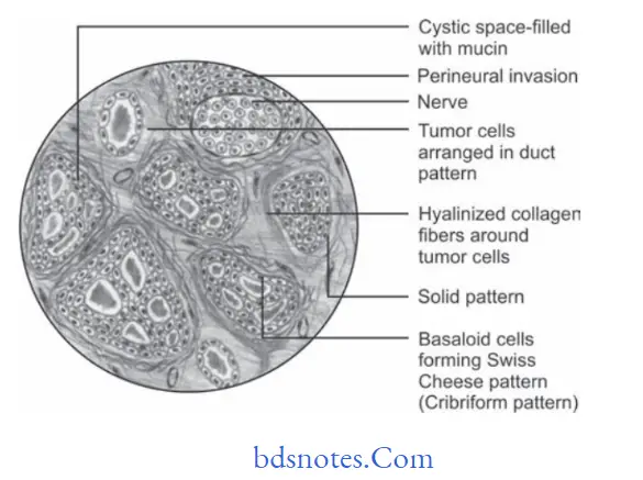 Tumors of Salivary Glands Adenoid cystic carcinoma