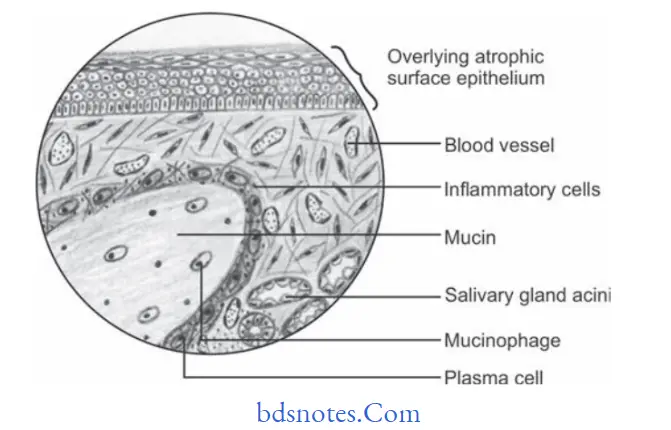 Tumors of Salivary Glands Mucous extravasation cyst