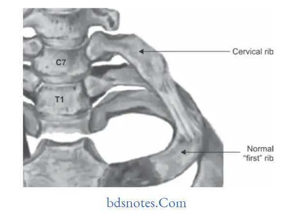 Upper Limb Ischemia Types of cervical rib