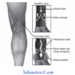 Venous Diseases Varicose vein of lower leg