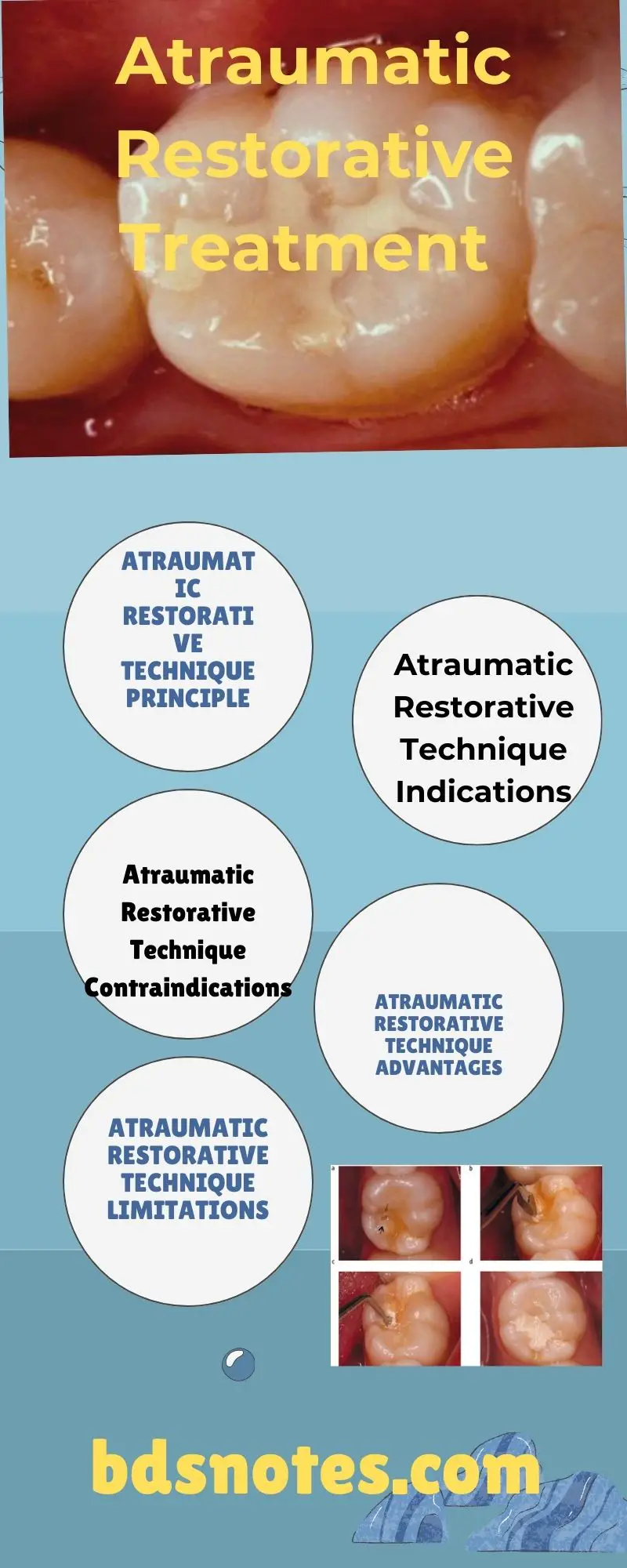 Atraumatic Restorative Treatment (ART) Question And Answers