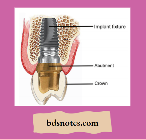 Components of endosseous implants