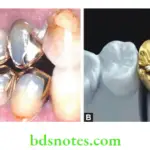 Dental Casting Alloy Gold onlays,A gold crown