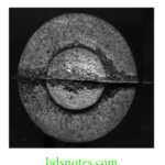 Dental Casting And Metal Fabrication Procedures Fins in casting.