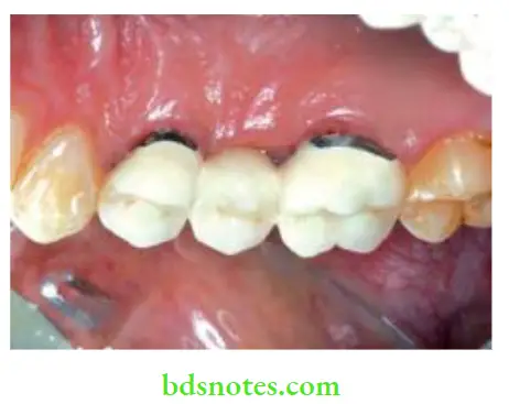 Dental Ceramics Porcelain-fused-to-metal fied partial denture.