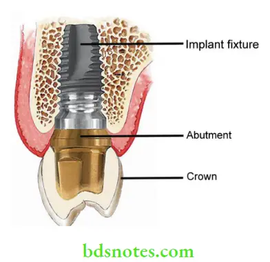 Dental Implant Materials Components of endosseous implants