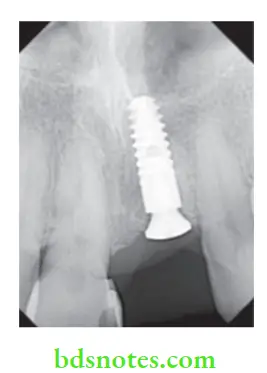 Dental Implant Materials Cover screw