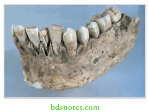 Dental Implant Materials Mayan mandible with shell implant