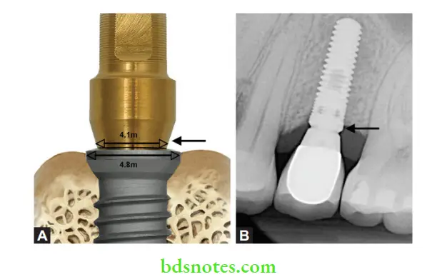 Dental Implant Materials Platform switching