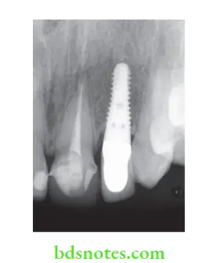Dental Implant Materials Radiograph showing an endosteal implant.