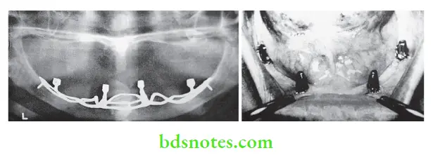 Dental Implant Materials Subperiosteal implant radiograph (left). Intraoral view (right)