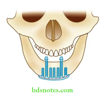 Dental Implant Materials Transosteal implant