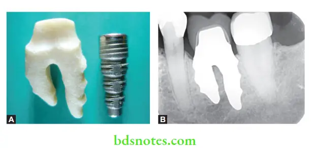 Dental Implant Materials Zirconia root form implants, Periapical view.