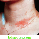 Dental Materials Biological Properties of Dental Materials Nickel allergy from a necklace