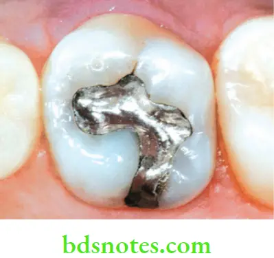 Dental Materials Dental Amalgam A completed amalgam restoration