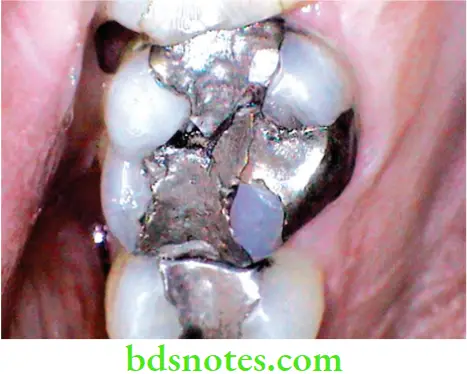 Dental Materials Dental Amalgam A fractured amalgam restoration